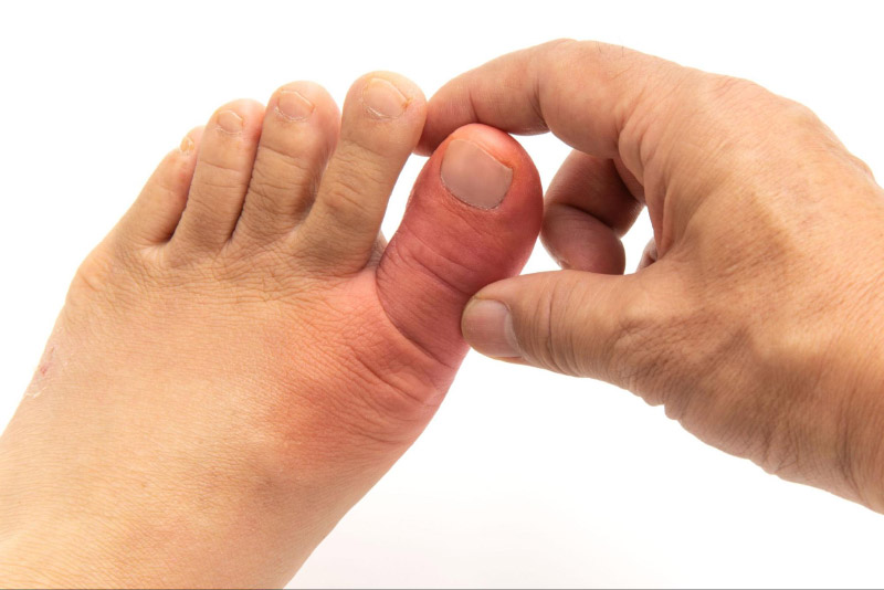 Yếu tố di truyền của bệnh gout