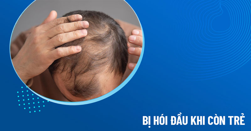 bị hói đầu khi còn trẻ