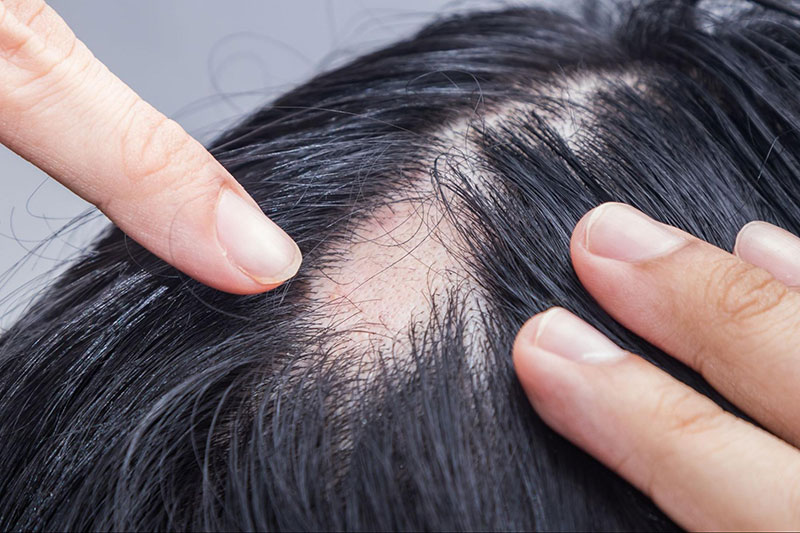 bị hói ở đỉnh đầu nữ giới