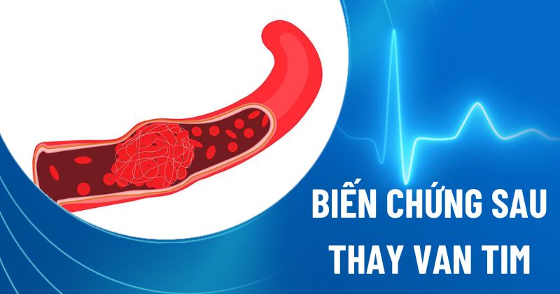 10 biến chứng sau thay van tim có thể xảy ra, nên thận trọng