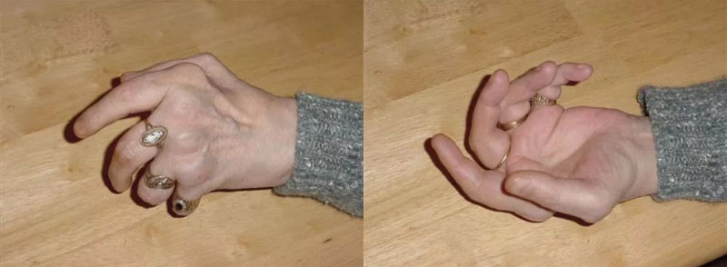 Biến dạng ngón tay do viêm khớp dạng thấp