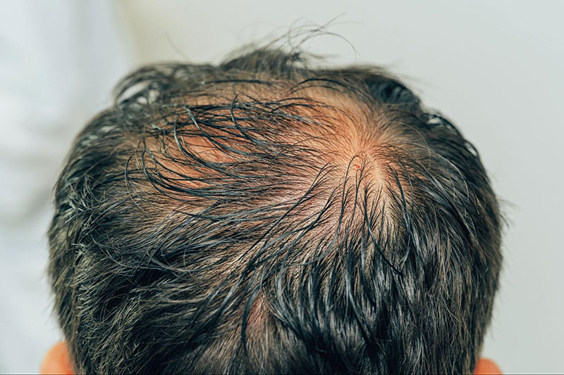 các khoảng trống trên da đầu lộ rõ