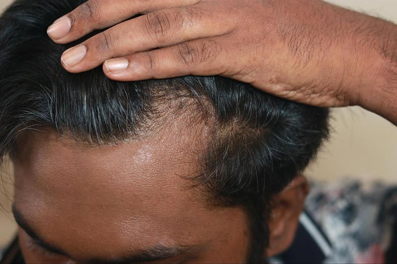 dấu hiệu hói nam giới