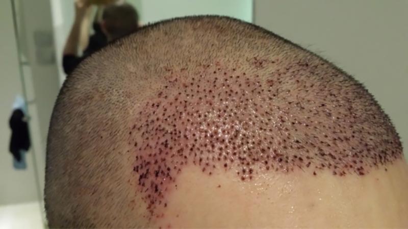 dấu hiệu nhiễm trùng sau cấy tóc