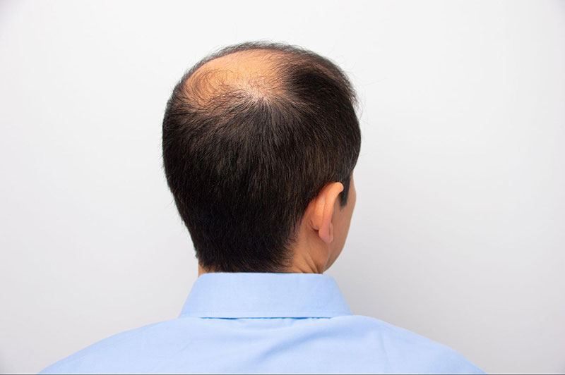 đỉnh đầu không còn tóc