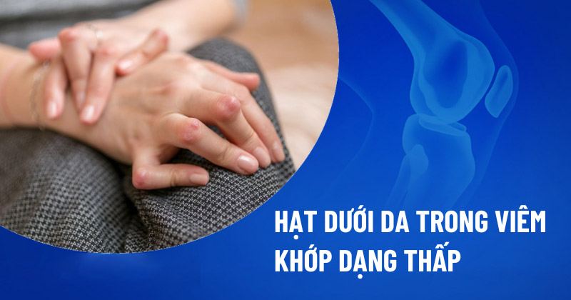Hạt dưới da trong viêm khớp dạng thấp