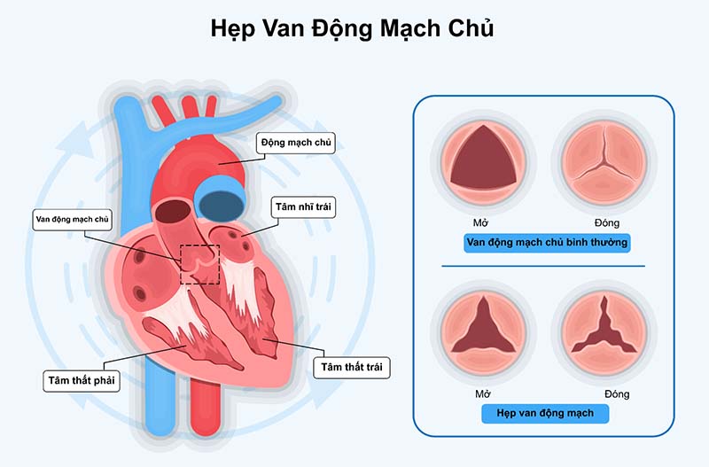 hẹp van động mạch chủ