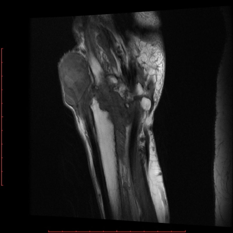 Hình ảnh Mri viêm khớp dạng thấp ở cổ tay