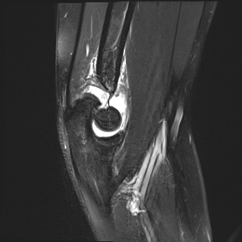 Hình ảnh Mri viêm khớp dạng thấp