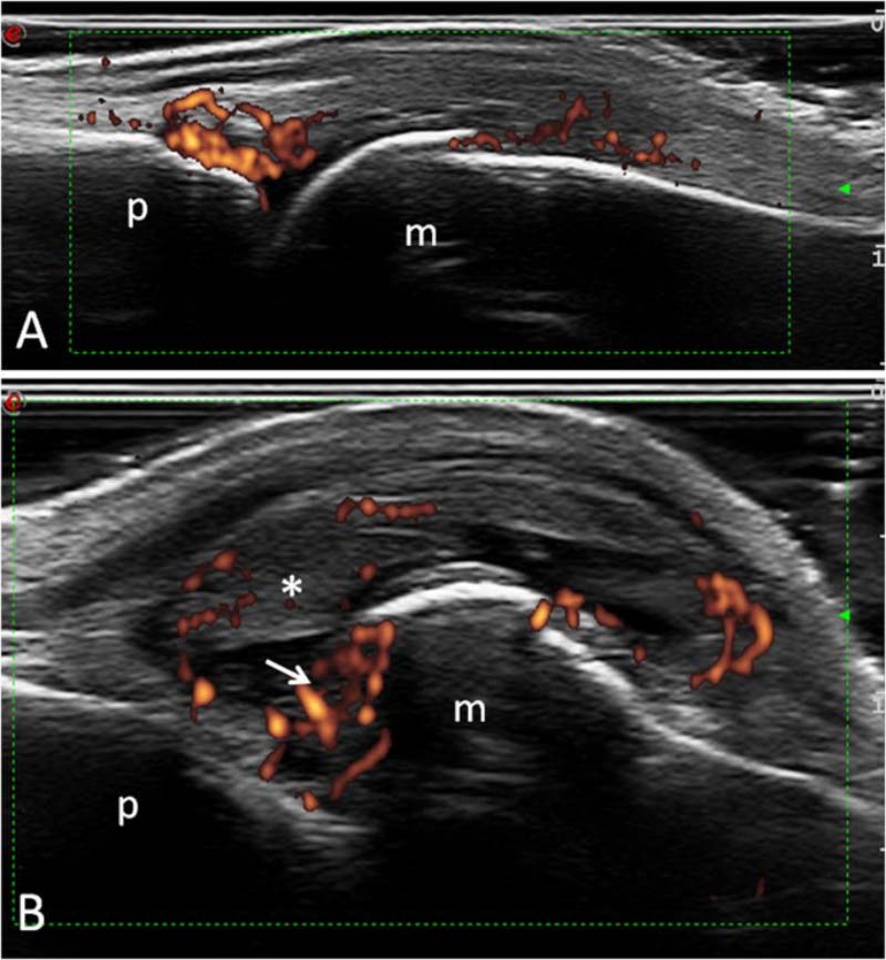 Hình ảnh siêu âm viêm khớp dạng thấp ở vai