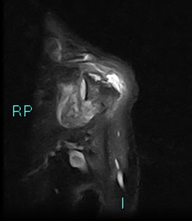 Hình ảnh viêm khớp dạng thấp tại vai giai đoạn cuối