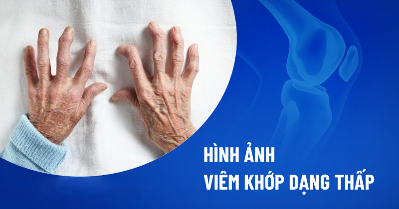 Hình ảnh viêm khớp dạng thấp