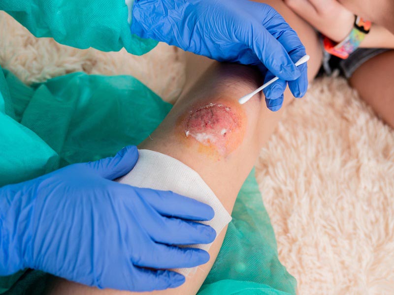 Không bôi thuốc Dermatix Ultra lên vết thương hở.