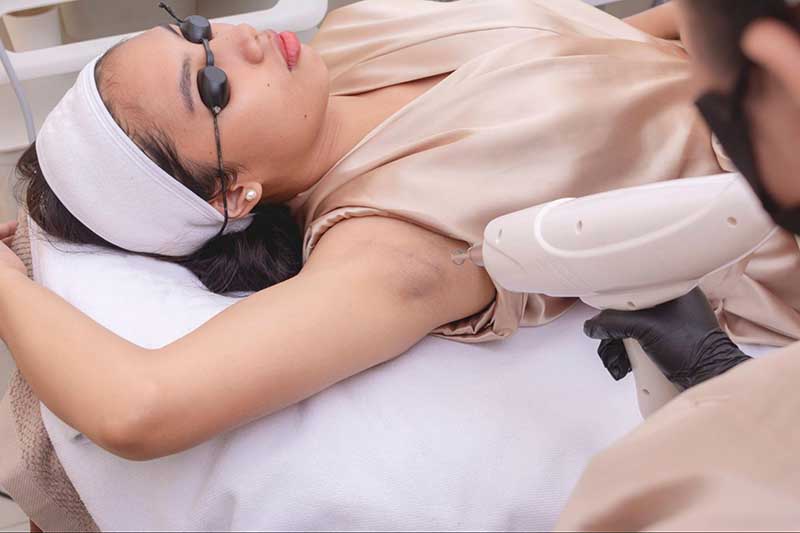 khử thâm nách bằng công nghệ laser