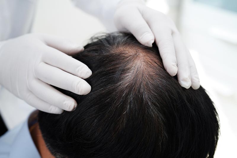 kiểm tra tình trạng hói đầu