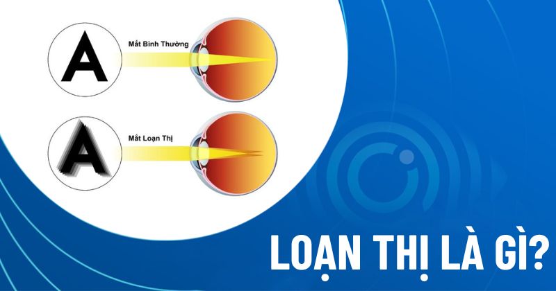Loạn thị là gì