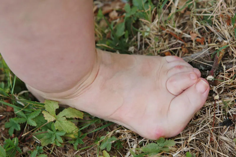 Ngón chân bị cong và biến dạng