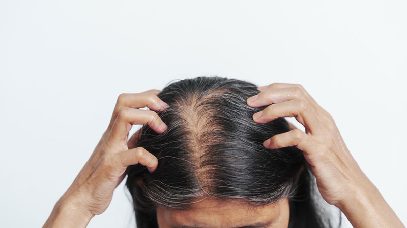 ngứa khi bị hói đỉnh đầu ở nữ