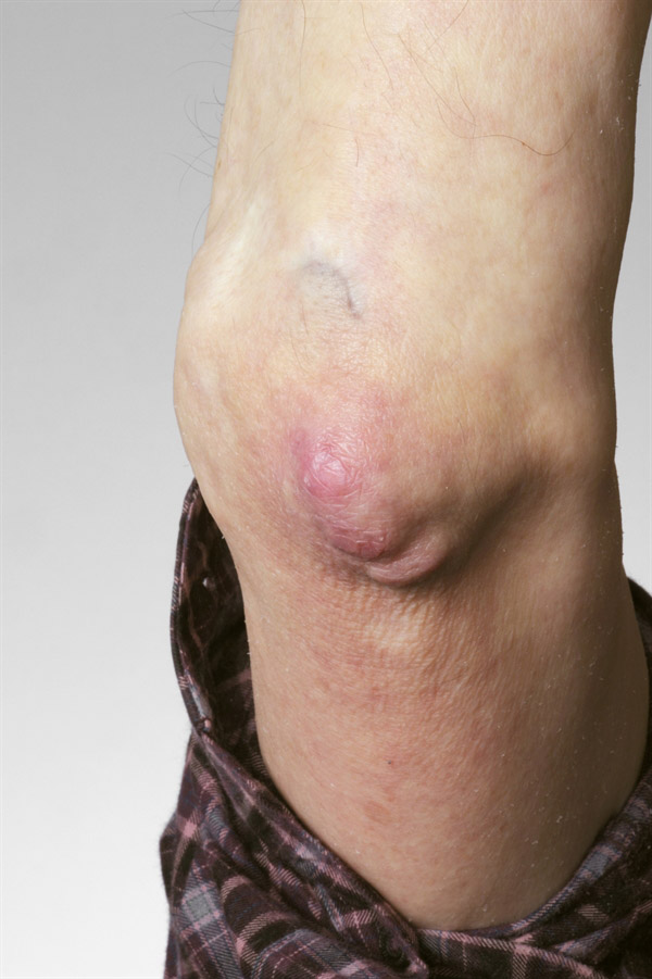 Nốt dạng thấp ở khuỷu tay