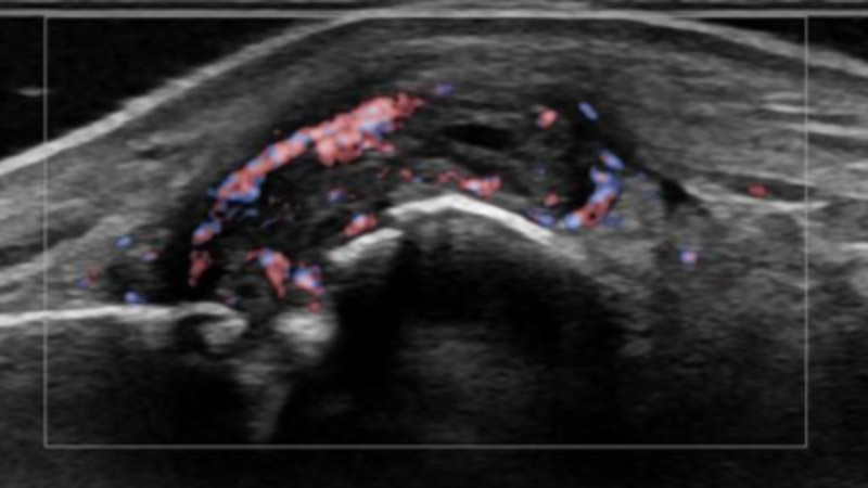 Siêu âm cơ xương trong viêm khớp dạng thấp