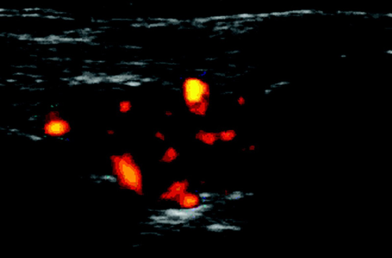 Siêu âm viêm khớp dạng thấp ở cổ tay