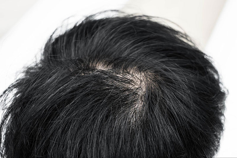 tóc rụng dần trên đỉnh đầu nam