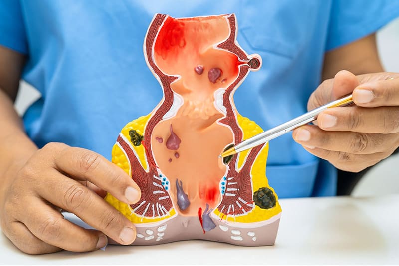 trĩ là tĩnh mạch ở hậu môn bị giãn nở và sưng viêm