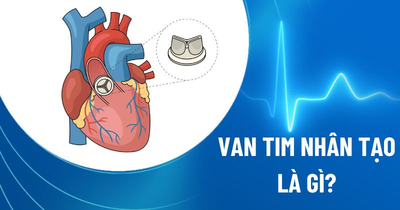 Van tim nhân tạo là gì? Phân loại, hình ảnh, ưu và nhược điểm
