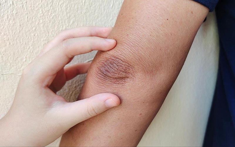 vì sao da vùng cùi chỏ thường sẩm màu