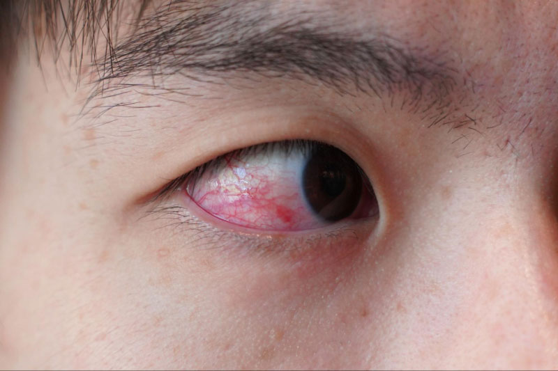 Viêm khớp dạng thấp gây khô, đổ mắt