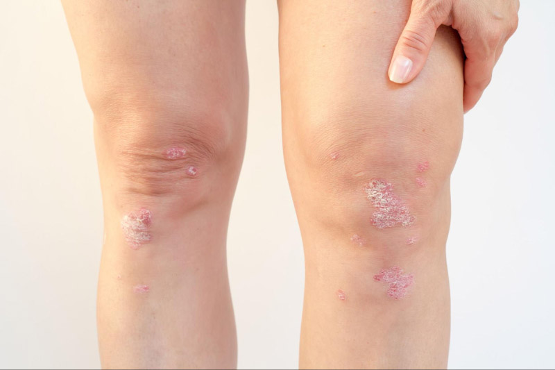 Viêm khớp đối xứng có thể xuất hiện cả ở 2 thể