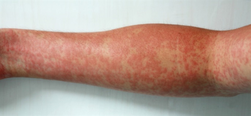 Viêm mạch dạng thấp