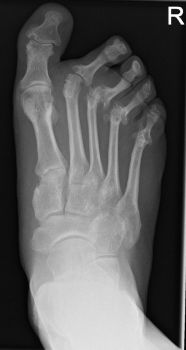 Xquang viêm khớp dạng thấp ở chân