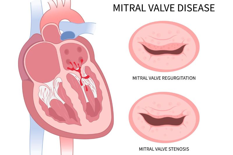 hình vẽ minh họa bệnh hở van 2 lá
