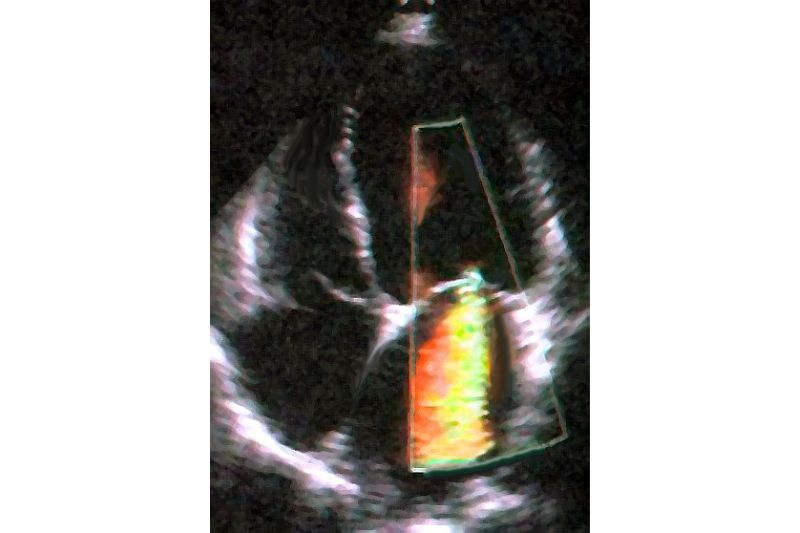 ảnh siêu âm tim thấy bệnh hở van hai lá nặng