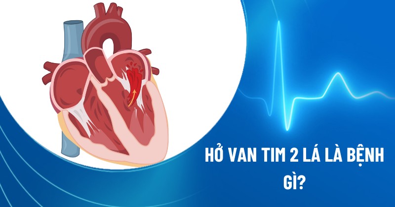 hờ van tim 2 lá