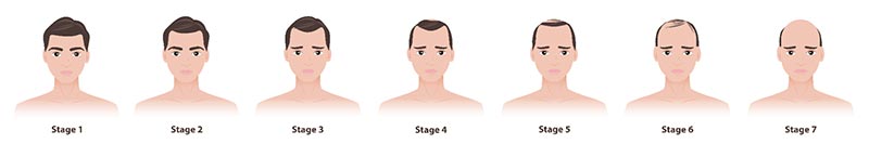 hói đầu ở nam giới theo thang đo hamilton