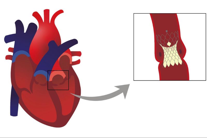 Thay van động mạch chủ qua da