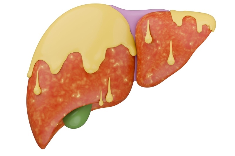 gan nhiễm mỡ trị bằng cà gai leo