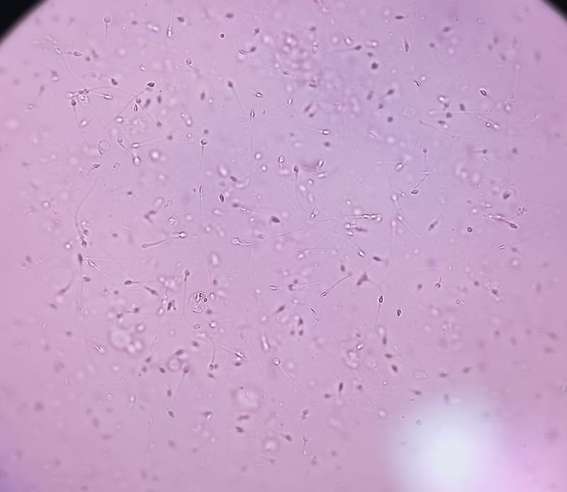 bệnh tuyến giáp ảnh hưởng tới chất lượng tinh trùng