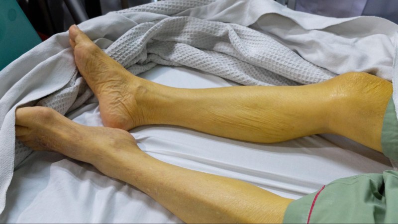 biến chứng gan nhiễm mỡ