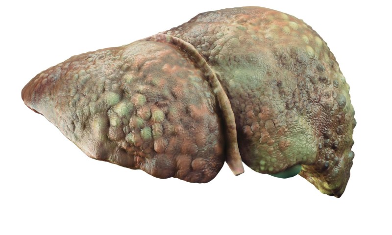 biến chứng viêm gan cấp do thuốc