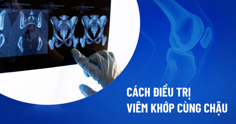 Cách điều trị viêm khớp cùng chậu