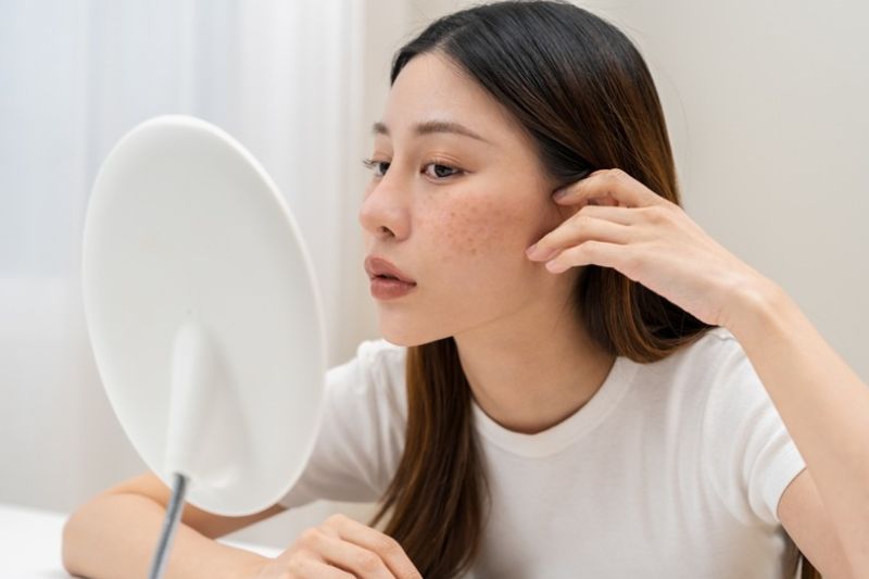 cám gạo không thể trị dứt điểm nám