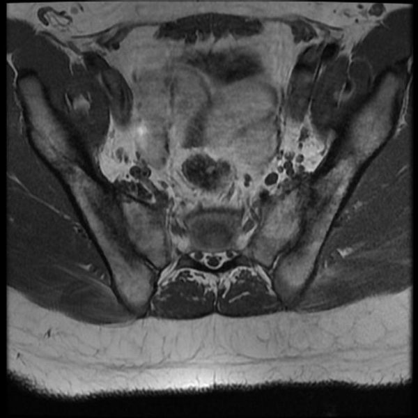 Chụp Mri hình ảnh viêm cột sống dính khớp