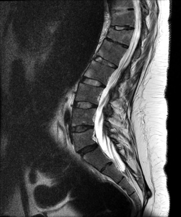 Hình ảnh viêm cột sống dính khớp bằng MRI