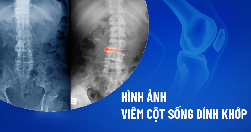Hình ảnh viêm cột sống dính khớp