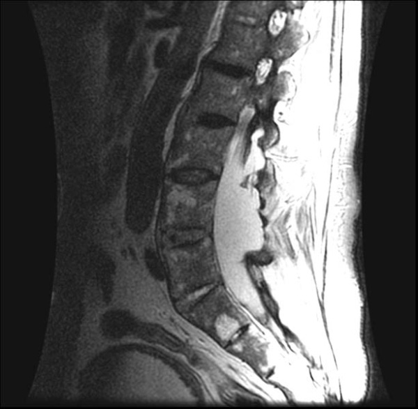 Hình MRI cho thấy màng cứng bao quanh tủy sống