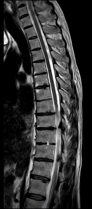 Hình MRI cột sống