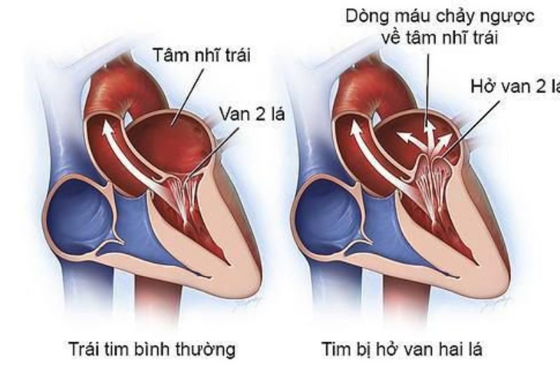 hở van hai lá